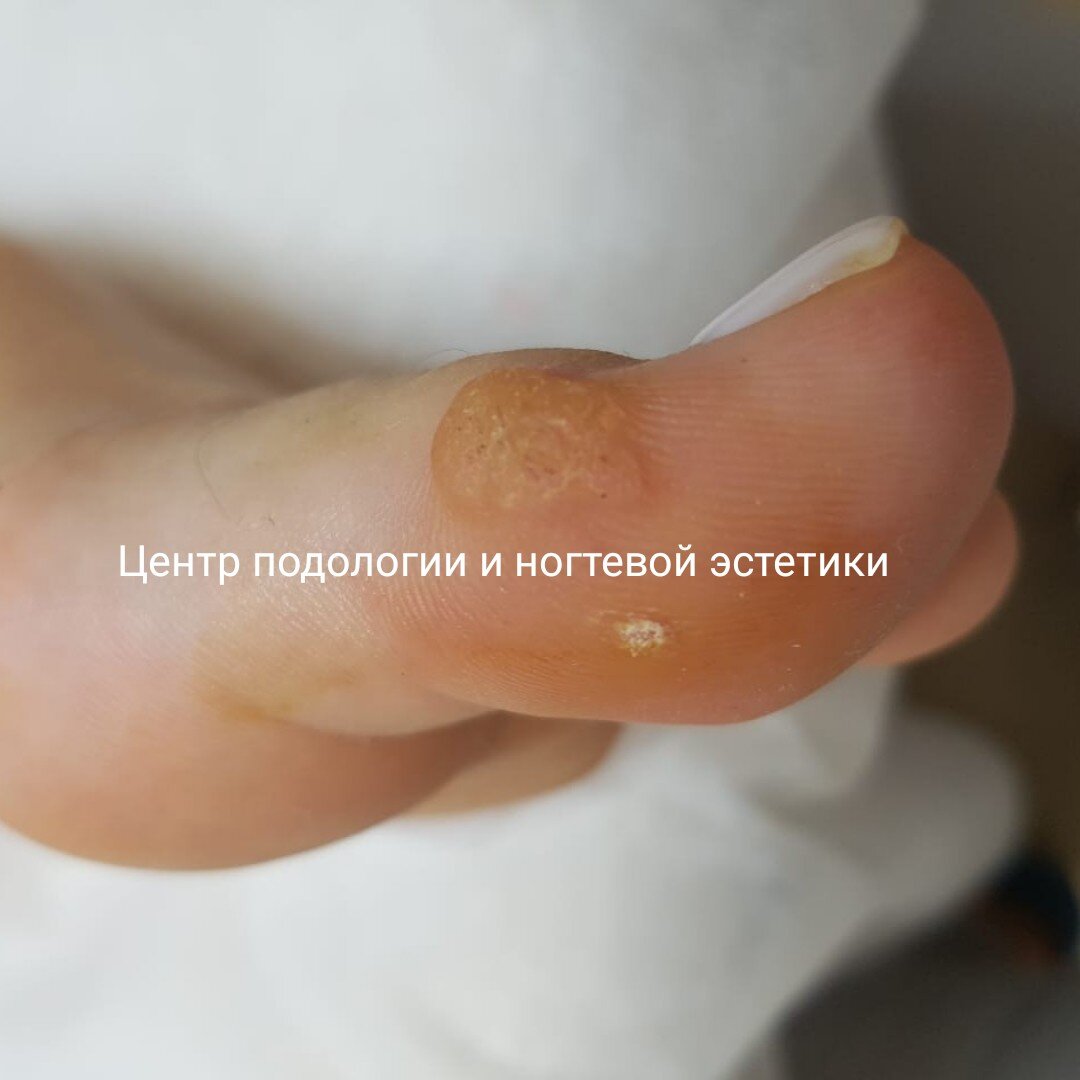 Первый приём.