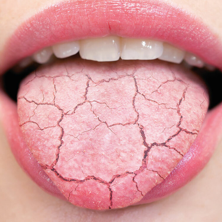 Трещины на языке