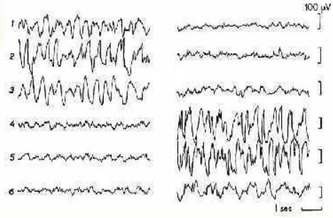 Однополушарный сон у дельфина афалины. Один столбик – левое полушарие, второй – правое. Большие волны – медленный сон, а маленькие – бодрствование в другом полушарии.