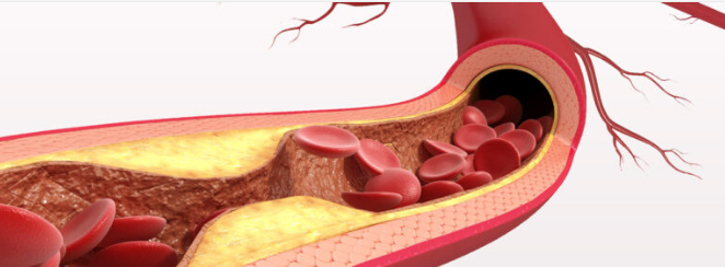 Рис. 1 Как лечить сосуды — вид бляшки внутри сосуда