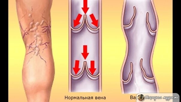 #варикозноерасширениевен #варикоз #народная медицина 