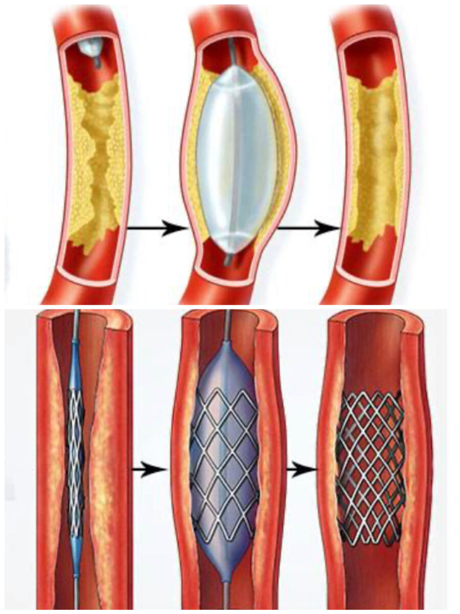 На первом изображении-ангиопластика(раздувание баллоном), на втором-стентирование(заведение, раскрытие и фиксация стента)