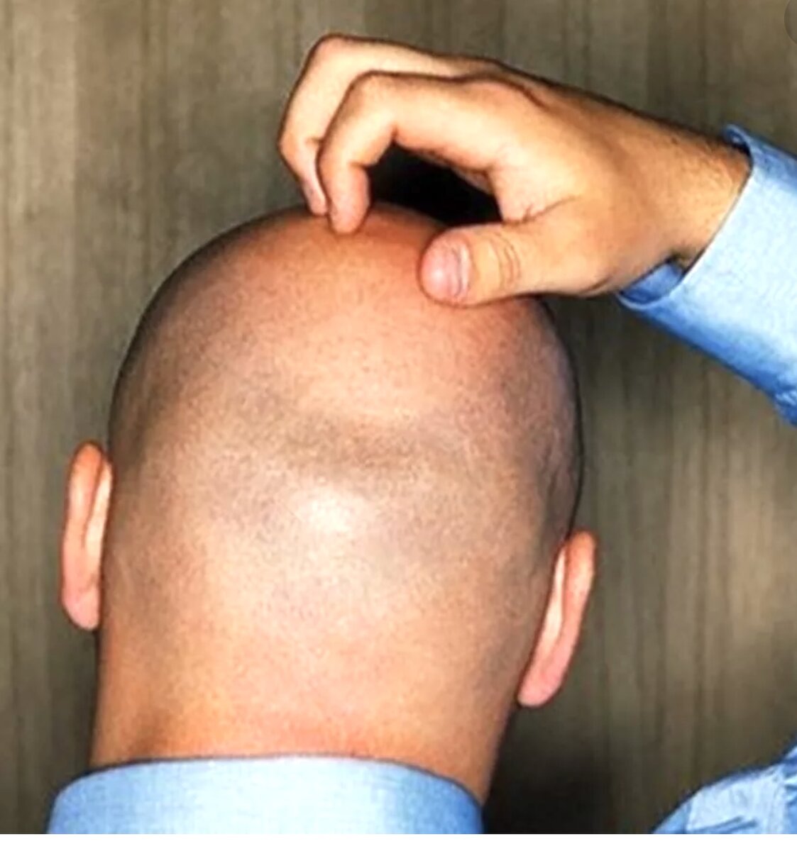 Пересадка волос - верный способ решить проблему облысения раз и навсегда 