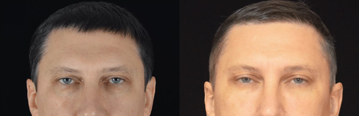 Мужская блефаропластика фото до и после. Фото с сайта Д.Р. Гришкяна. Имеются противопоказания, требуется консультация специалиста