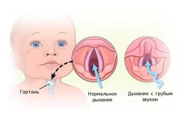 Ларингит у детей: симптомы и лечение