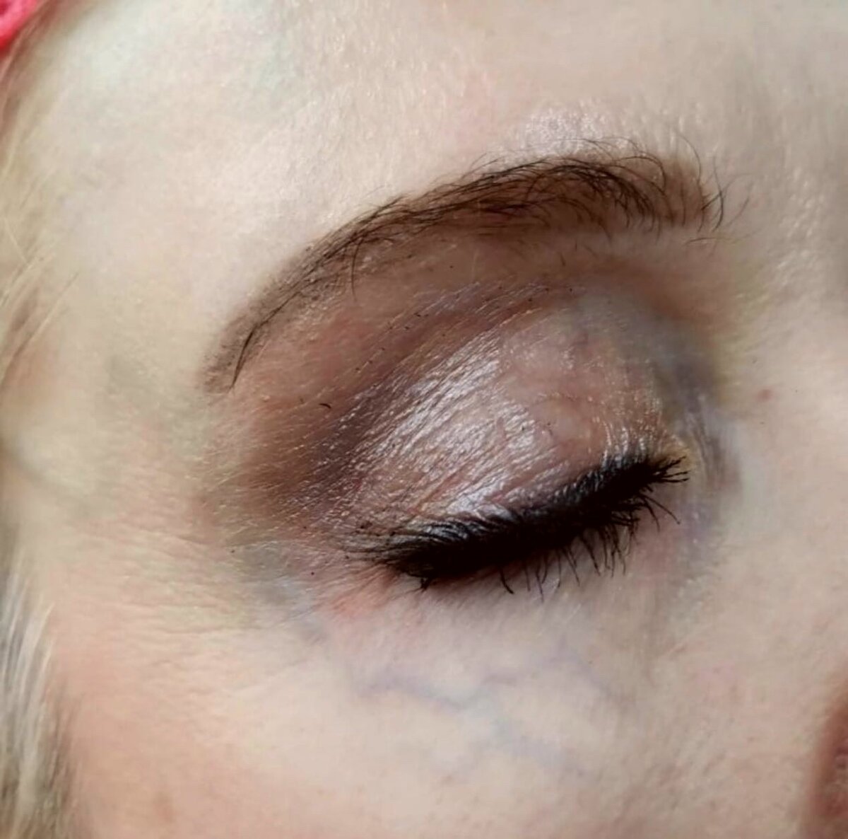 Вид пациентки с некрасивыми венами вокруг глаз. Клинический материал Центра сосудистой патологии "ГЕМАНГИОМА". 