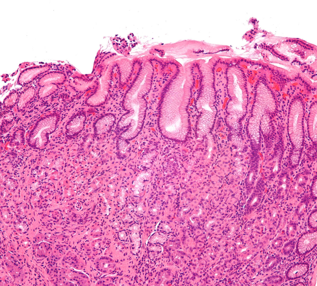Слизистая оболочка жкт. Гипертрофический гастрит гистология. Атрофический гастрит гистология. Атрофический гастрит патанатомия. Хронический гастрит микропрепарат.