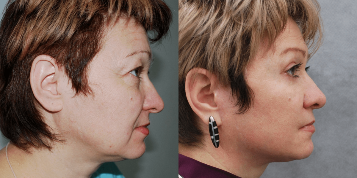 Фото до и после подтяжки лица. Фото с сайта Д.Р. Гришкяна. Имеются противопоказания, требуется консультация специалиста