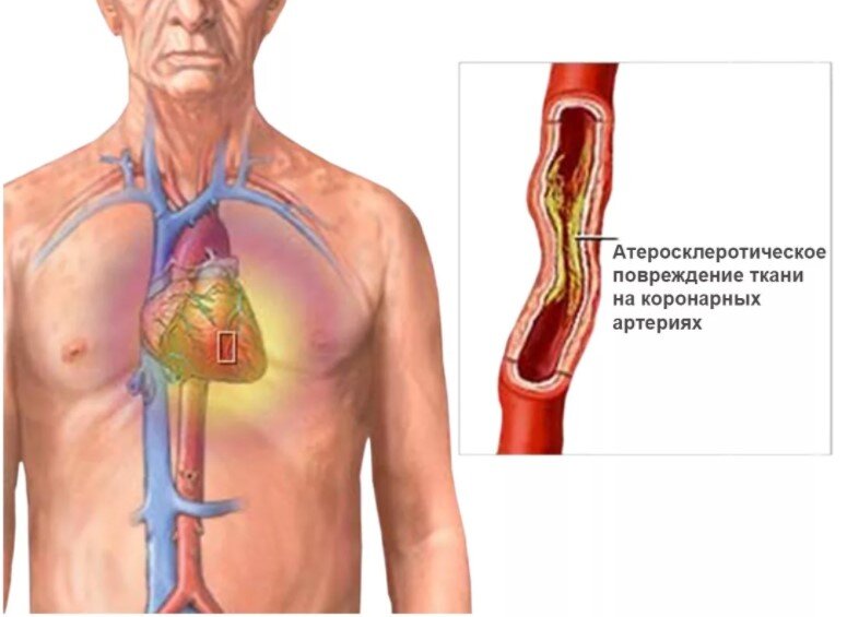 Признаки, причины и виды стенокардии