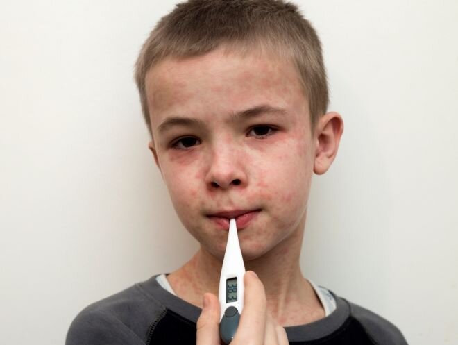Ребенок больной корью.