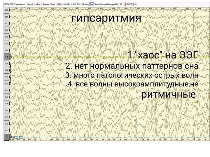 Паттерн гипсаритмия на ЭЭГ.Синдром Веста является классической эпилептической энцефалопатией, что подразумевает за собой страдание головного мозга на фоне постоянной эпилептической “бомбардировки” что отражается на ЭЭГ типичной ( но не специфичной) для синдрома Веста патологическим изменением биоэлектрической активности- гипсаритмией.