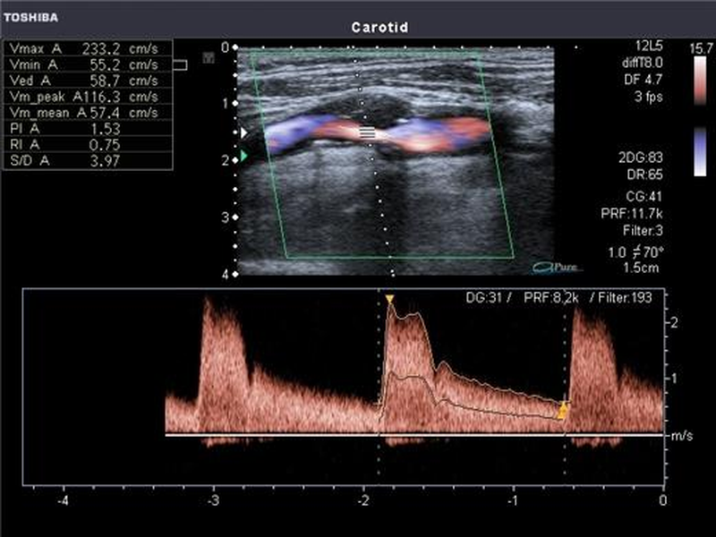 Что покажет узи сосудов шеи и головы. Расшифровка УЗИ шейных сосудов. Наружная Сонная артерия на УЗИ. Триплексное сканирование брахиоцефальных артерий. УЗИ допплер сонных артерий.