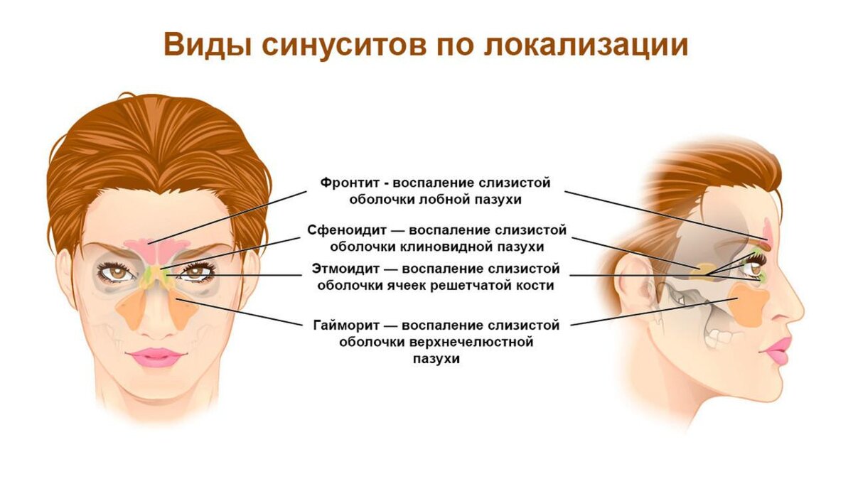 Как избавиться от хронического насморка