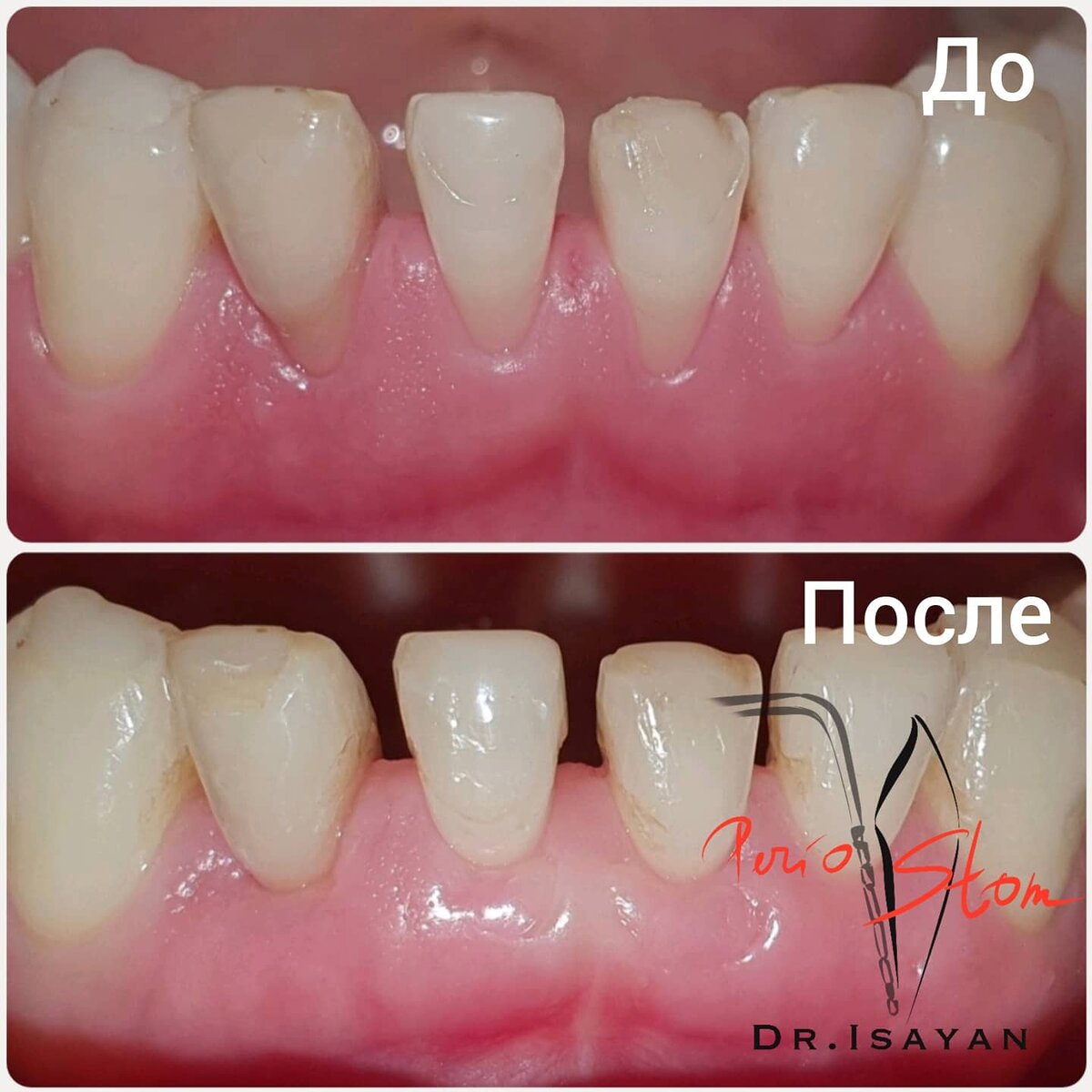 На фото ситуация до наращивания десны и состояние десны через 4 месяца после наращивания. 