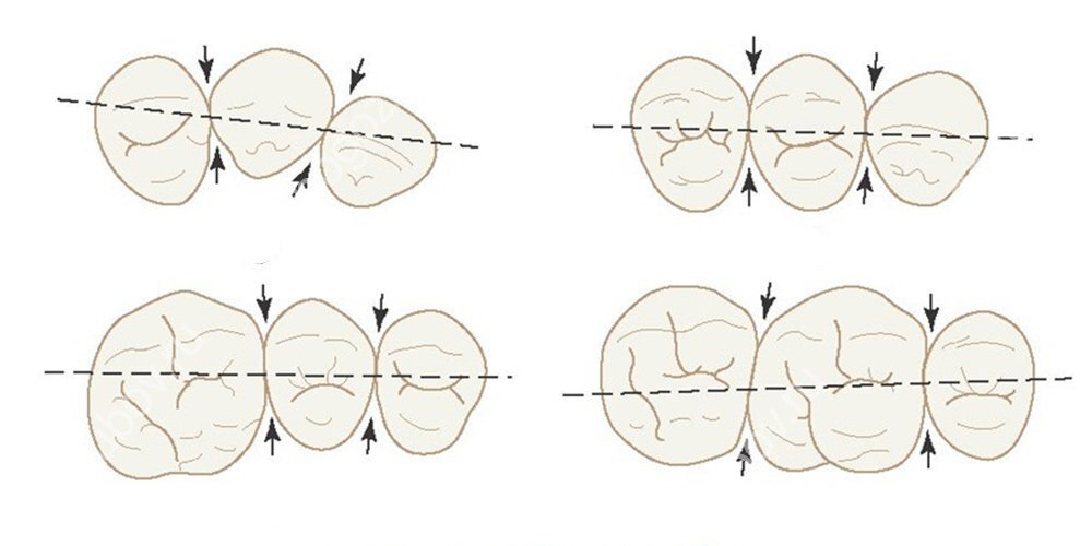 При прохождении ниткой Вы услышите щелчок - показатель точечного здорового контакта между зубами