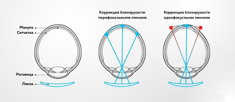 Перифокальные очки фото