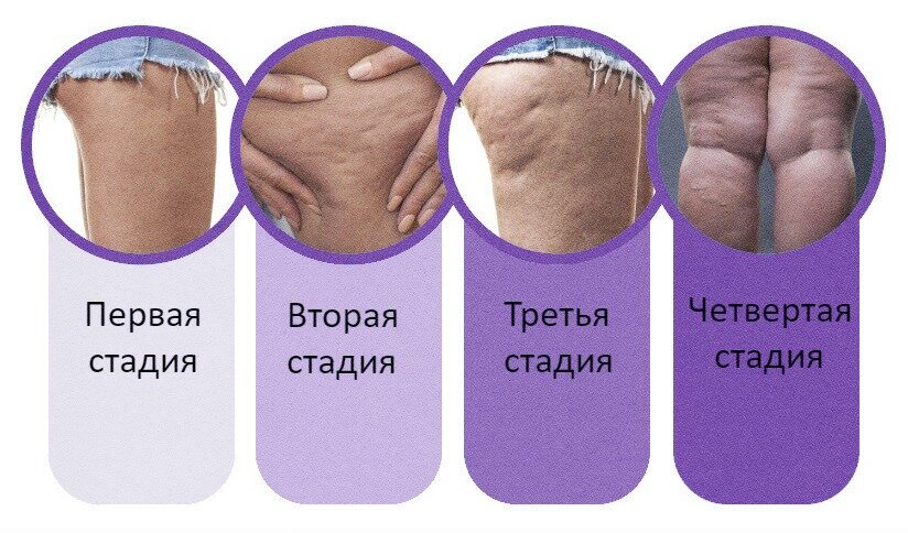 стадии развития целлюлита
источник: resedaodor.com