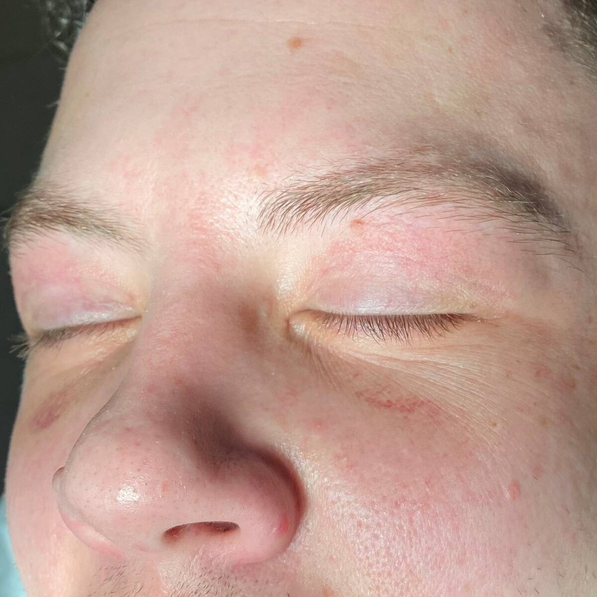 Вид рубца на 12 день после операции 