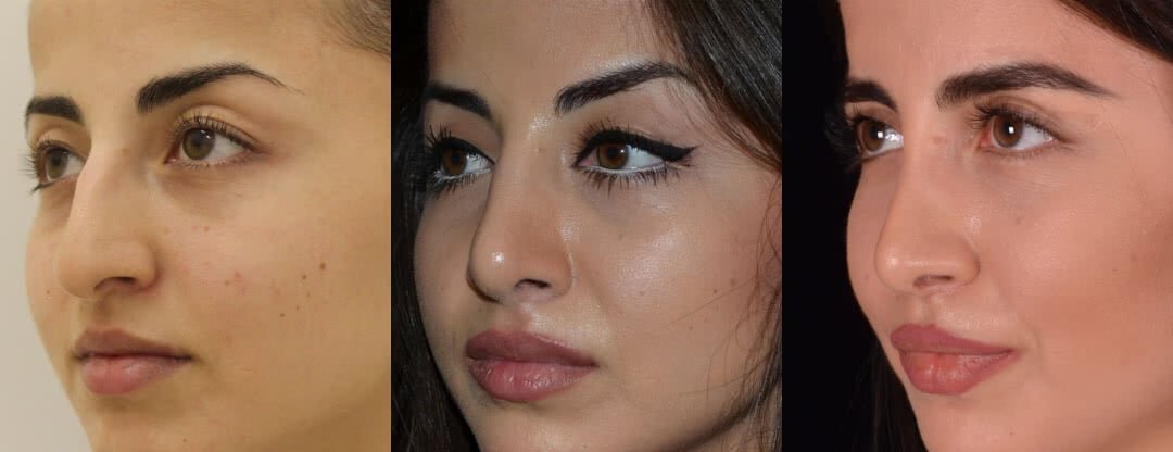 Ринопластика носа фото до и после. Фото с сайта Д.Р. Гришкяна. Имеются противопоказания, требуется консультация специалиста