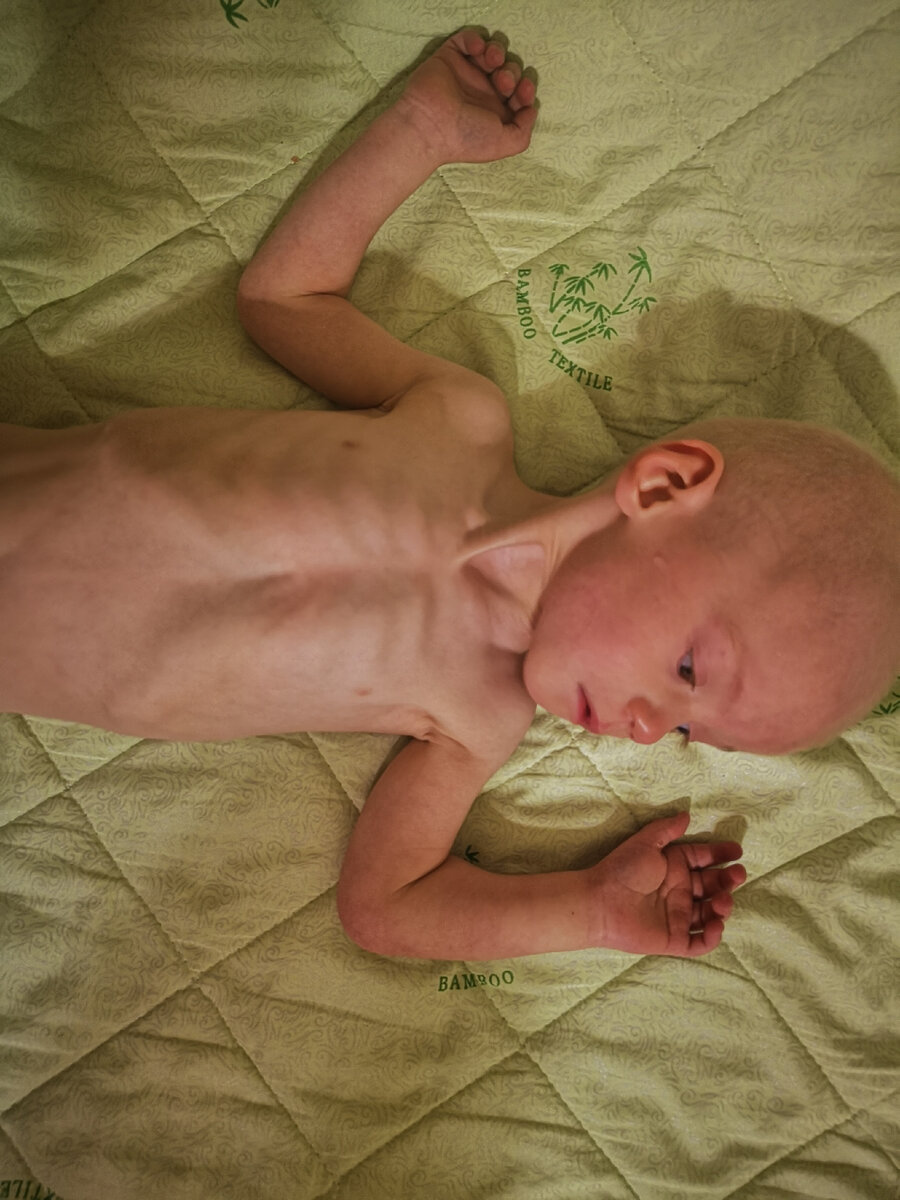 После дома ребёнка Серёжа почти в 2 года весил 6 кг. Он был на грани жизни и смерти