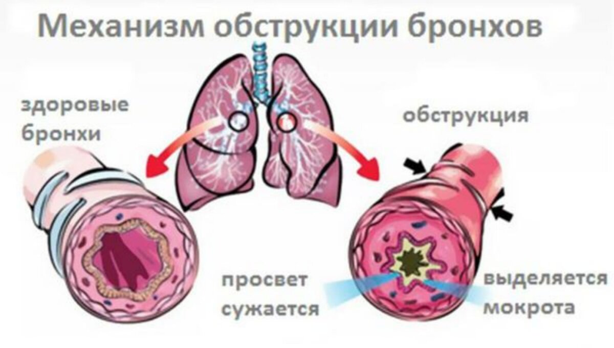 Бронхоспазм как снять быстро препараты Острый бронхит. Рассказывает психолог Юлия Вольфовская. Психосоматика yuliya_psy