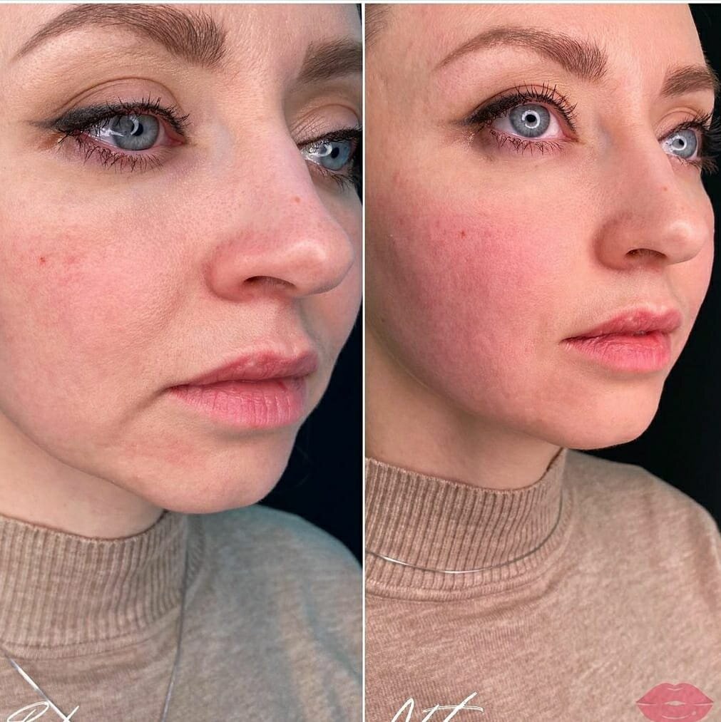 Результат от процедур SMAS-лифтинга