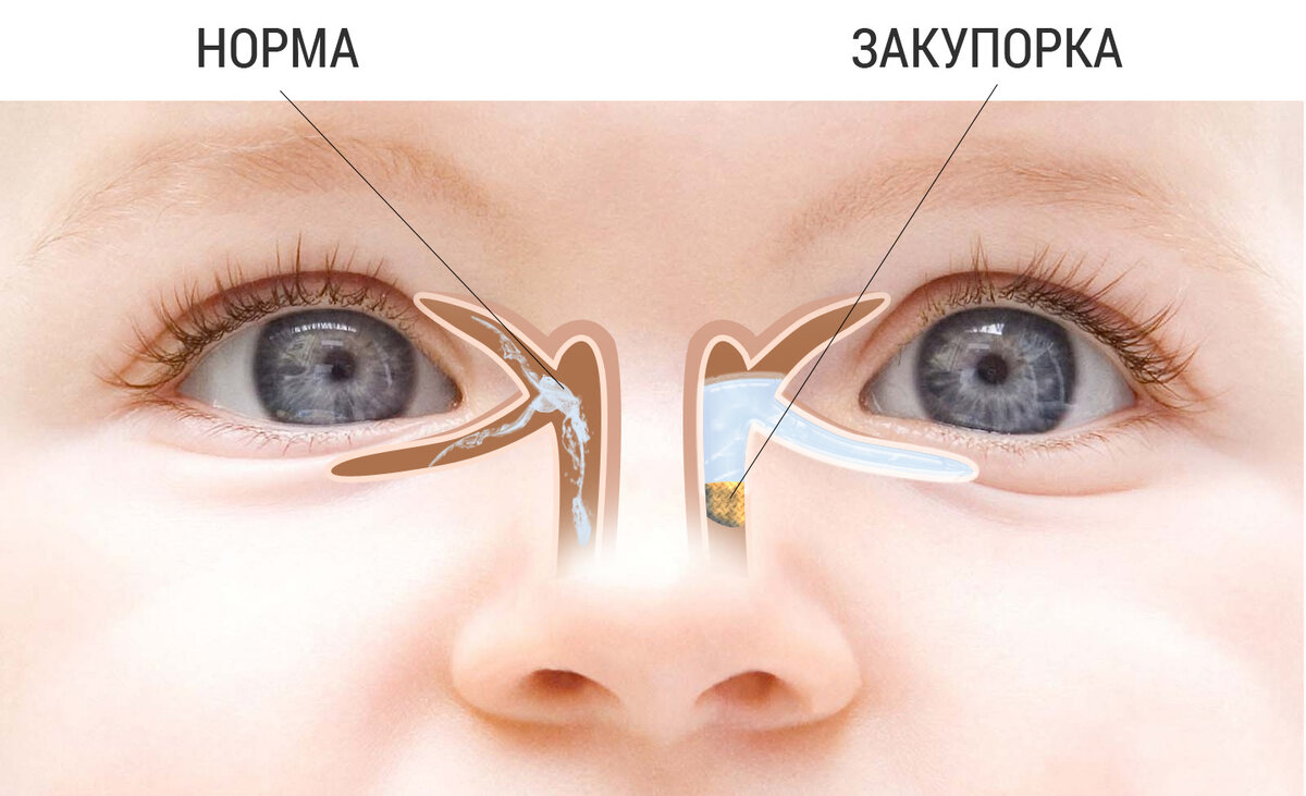 Массаж слезного мешка у новорожденных | Фэнтези