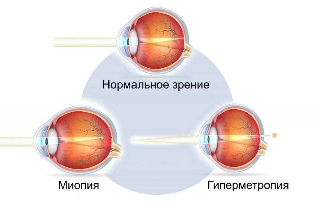 Плюс в даль зрение. Заболевания глаз близорукость и дальнозоркость. Дальнозоркость и близорукость строение глаза. Строение глаза дальнозоркость. Строение глаза человека близорукость и дальнозоркость.