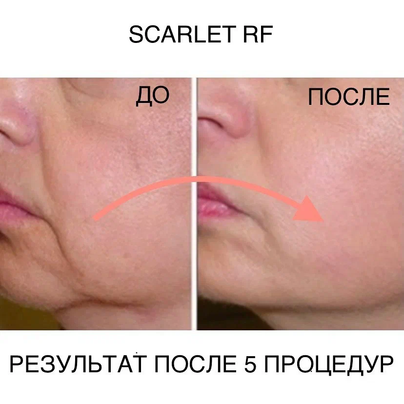 Фракционный лифтинг на аппарате Scarlet RF. Фото до и после. Фото с сайта Д.Р. Гришкяна. Имеются противопоказания, требуется консультация специалиста