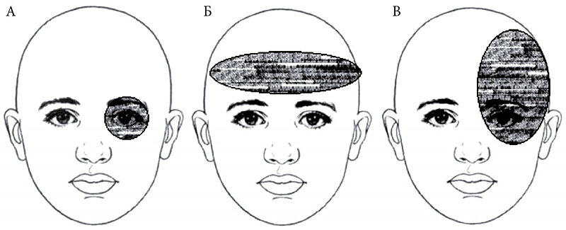 Локализация разных типов головной боли: А – кластерная; Б – головная боль напряжения; В – мигрень