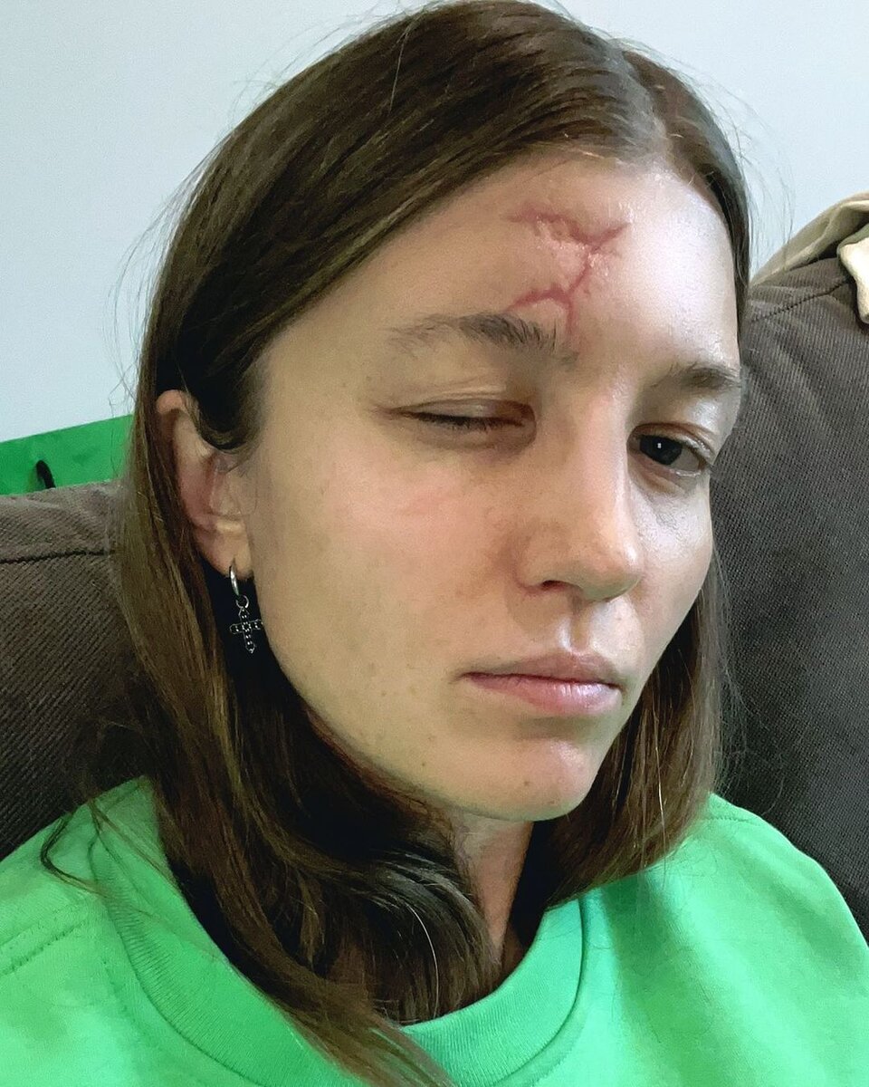    Маша Шейх рассказала о последствиях черепно-мозговой травмыСоцсети Маши Шейх