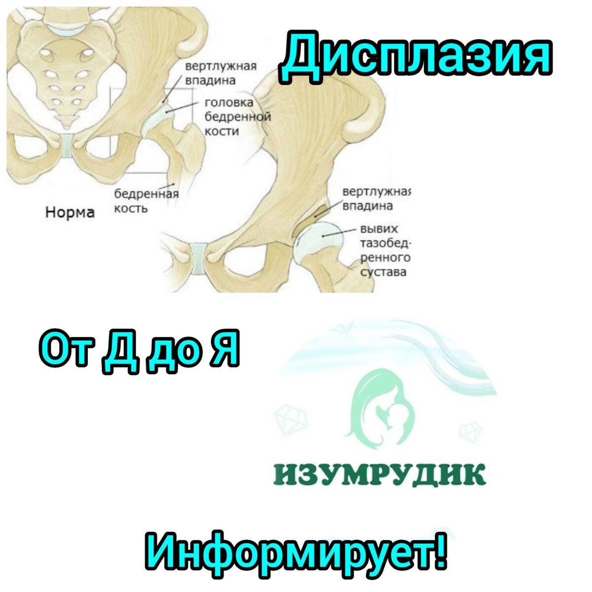 Дисплазия от Д до Я. Мифы и реальность. На что обратить внимание, чтобы не  пропустить важное. | Малыш до года Изумрудик 💎 | Дзен