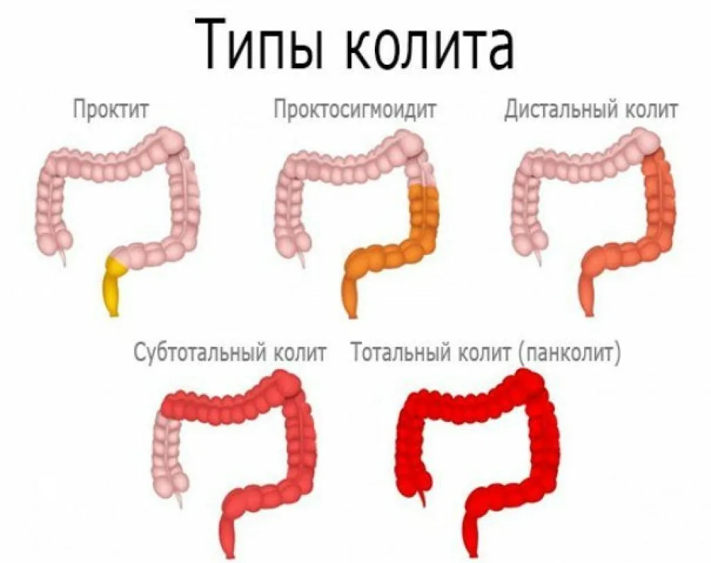 Псевдомембранозный колит: диагностика и лечение в СВАО на Минусинской