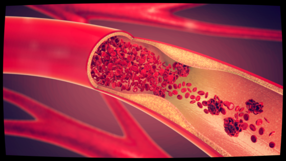 Атеросклероз сосудов: причины и лечение | Клиника Рассвет