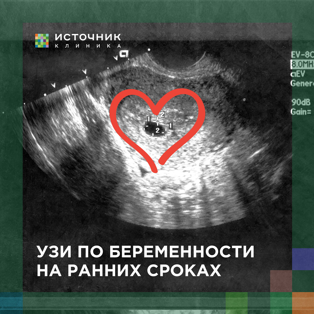 Чем раньше будущая мама придет к врачу, тем выше шансы выносить здорового малыша