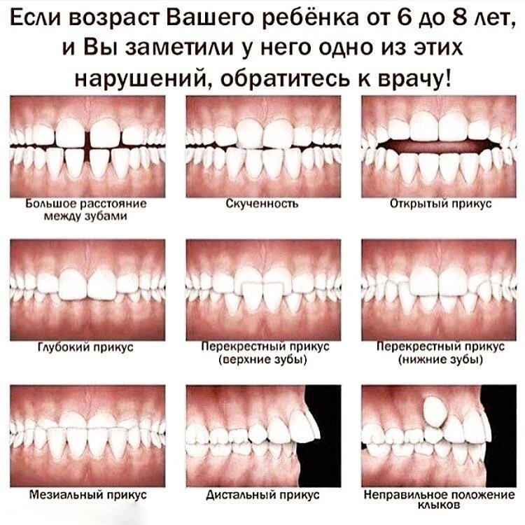 Как исправить неправильный прикус у ребенка