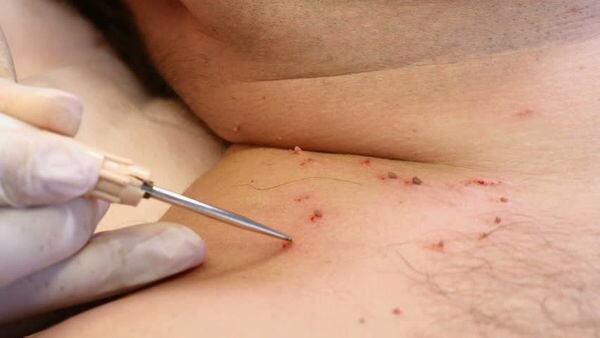 Удаление папилломы. Фото: probolezny.ru
