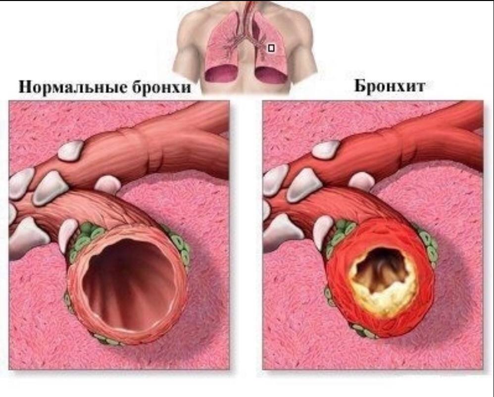 Бронхит что это. Бронхитол.