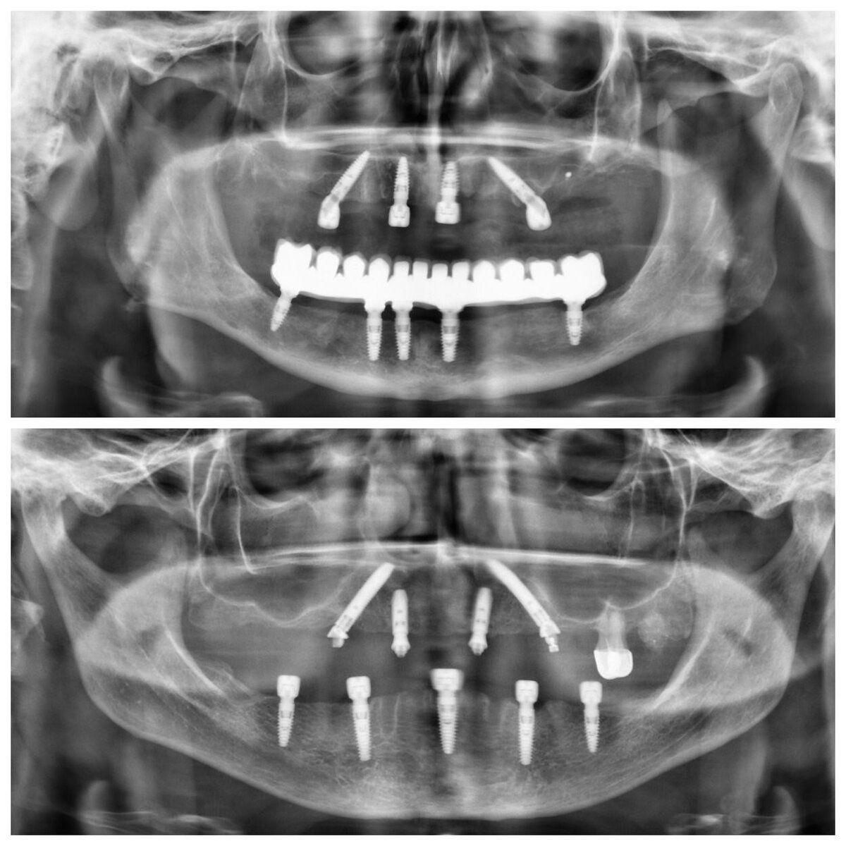 Меня часто спрашивают о стремительно набирающей в России популярность стоматологической операции «All-on-4» и «All-on-6». Отвечаю.