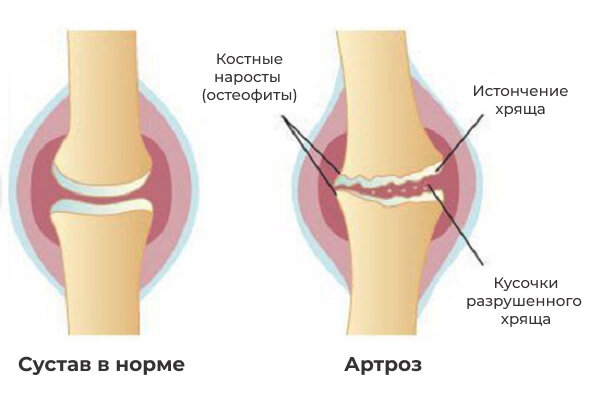 Артроз суставов кисти