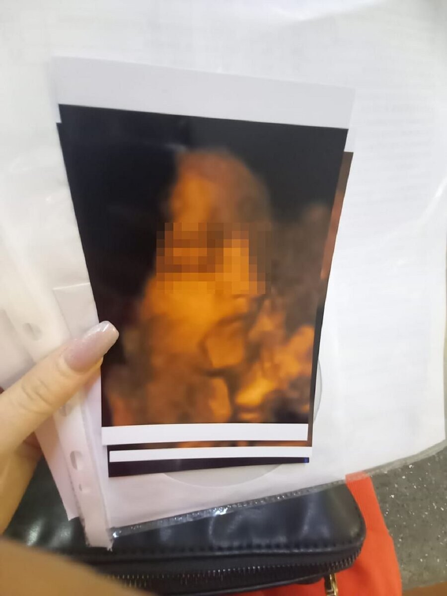     По УЗИ отклонений в развитии и состоянии ребенка не было. Фото: предоставлено Анной.