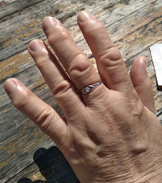 Типичный артрит пальцев рук. Суставы воспалены, деформированы