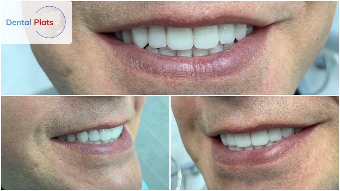 Постоянные зубы выполненные по методике "Зубы за 1 день"