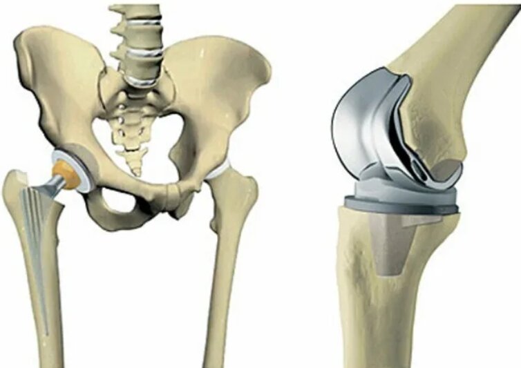 Замена коленного сустава. Гемипротез тазобедренного сустава. Титановый эндопротез тазобедренного сустава. Искусственный эндопротез тазобедренных суставов. Эндопротез коленного сустава Титан.