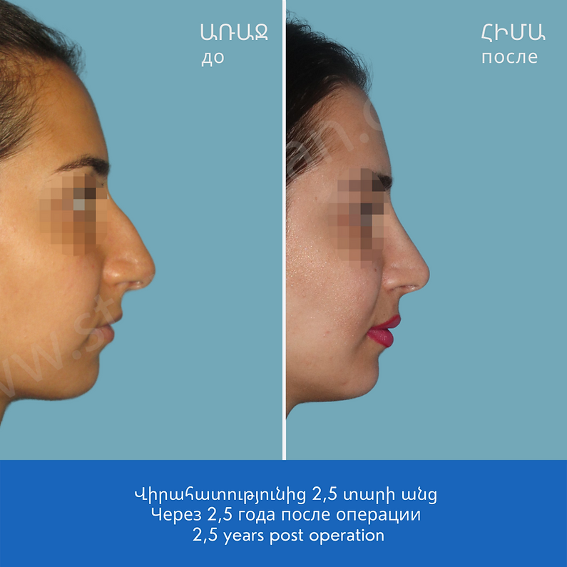 Результат ДО и ПОСЛЕ