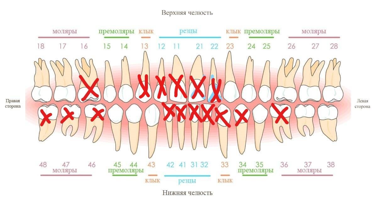 Удаленная зуб сколько