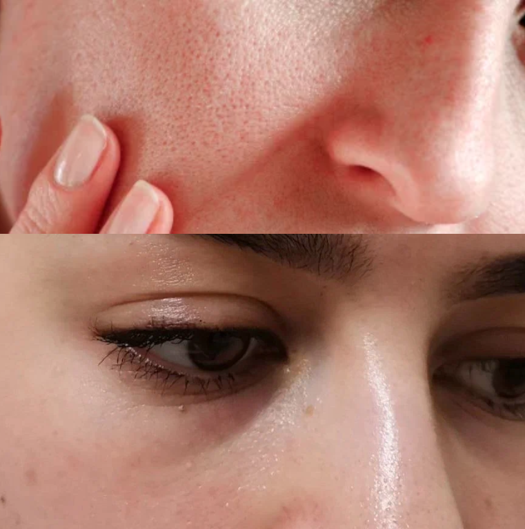 LANBENA Blackhead Remover Face Serum Shrinking Pore Purifying Acne Treatment Ess