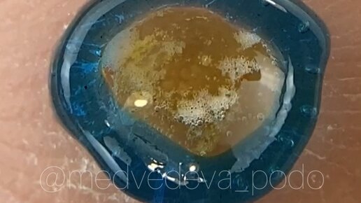 Medvedeva_podo | Реакция белок+азотная кислота. Выглядит увлекательно?? ...