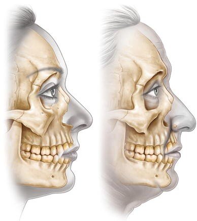 Возрастное разрушение костей лица 