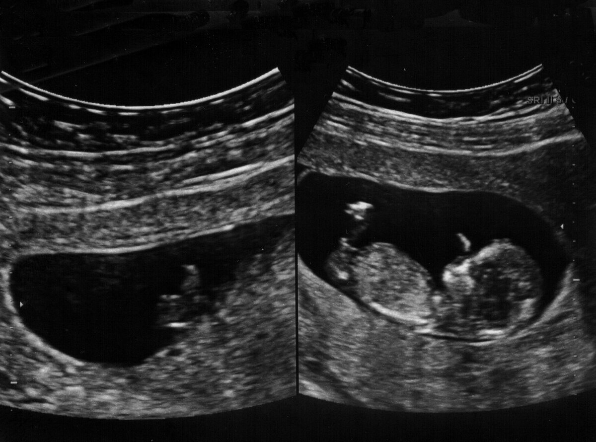 Беременная двойней карагандинка пожаловалась на врачей из-за смерти плода